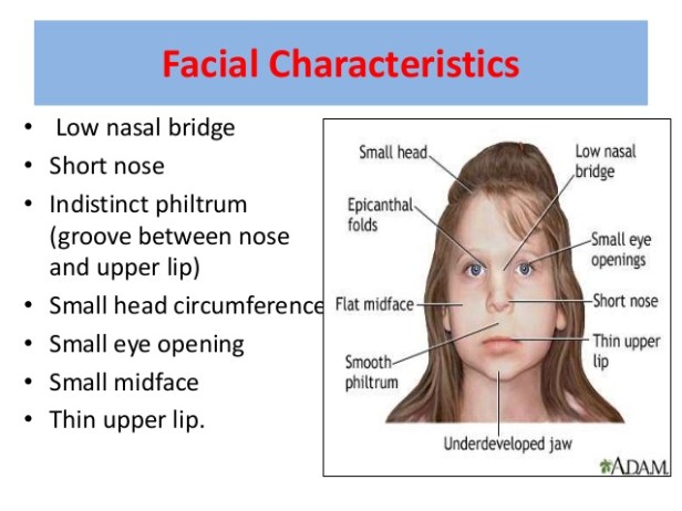 fetal-alcohol-syndromefas-9-638