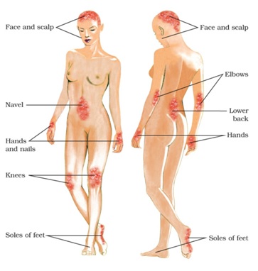 fig 2 psoriasis body parts